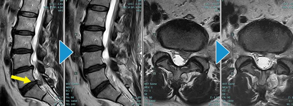 MRI：術前→術翌日