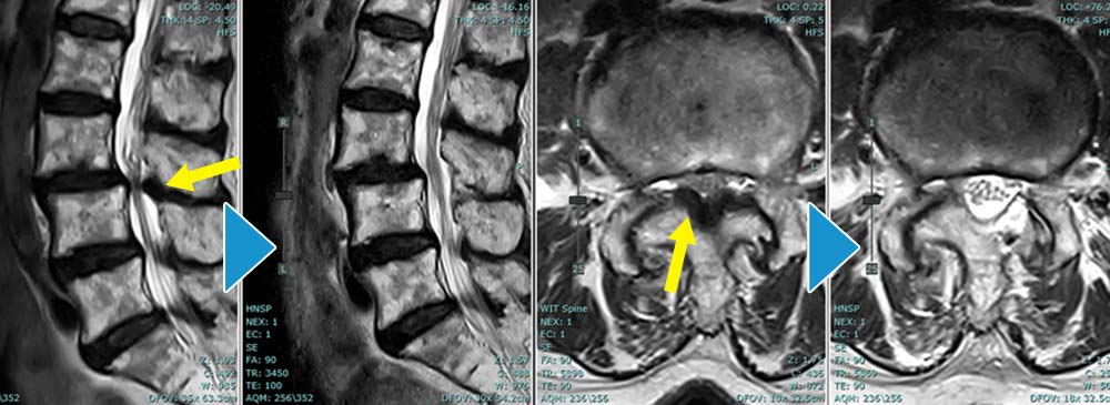 MRI：右C6/7