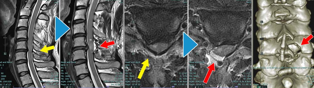 MRI：右C6/7