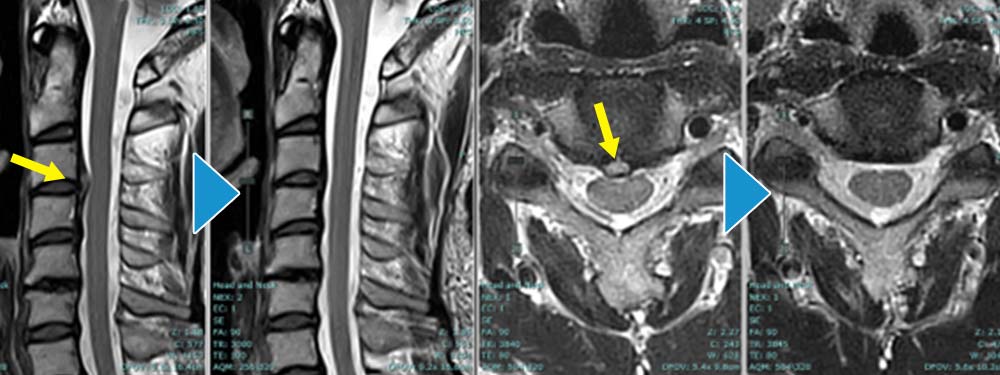 MRI：術前→術後6ヶ月