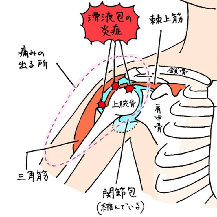 腰椎圧迫骨折のイメージ画像